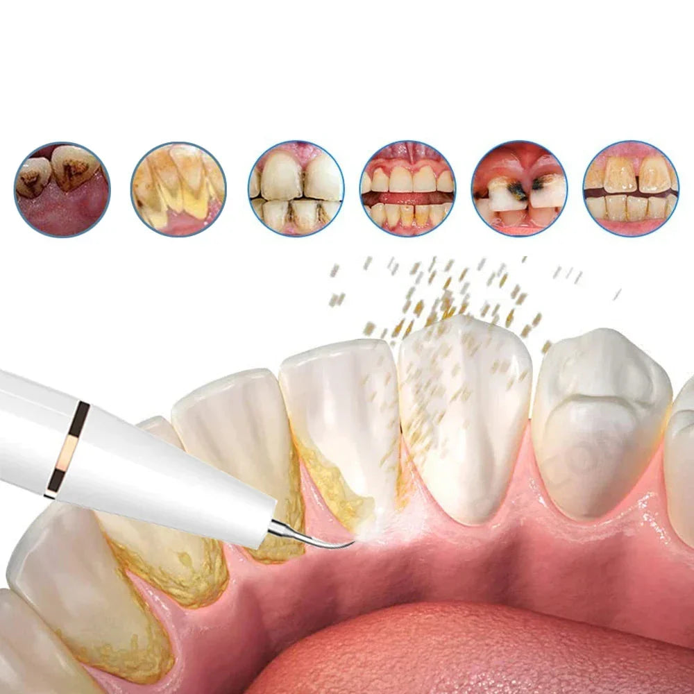 USB Ultrasonic Dental Plaque Remover Tool