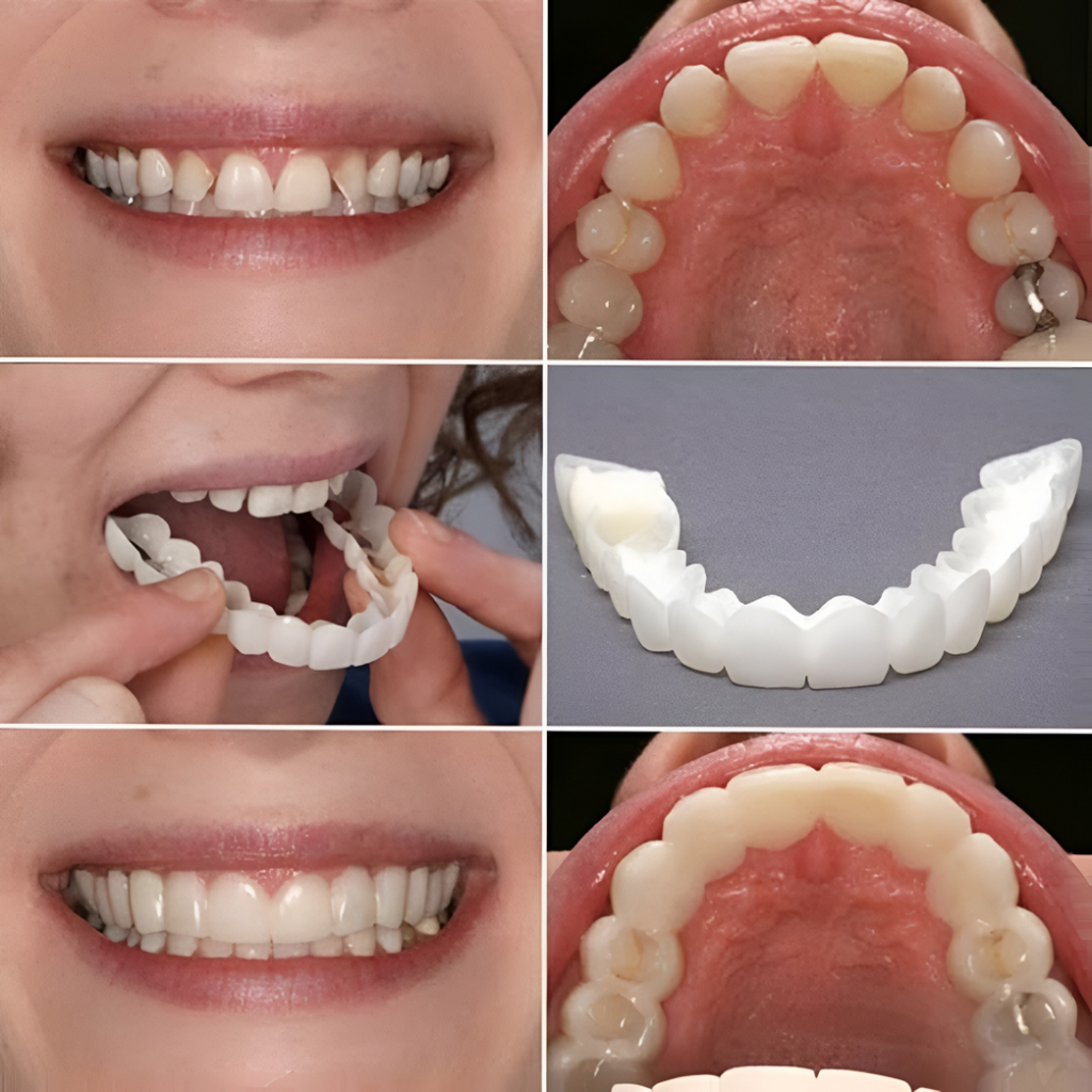 Snap-On Cosmetic Tooth Veneers for Instant Smile Cover