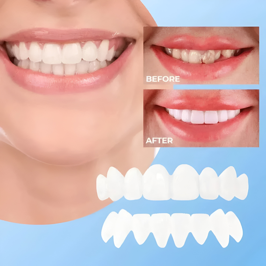 Snap-On Cosmetic Tooth Veneers for Instant Smile Cover